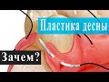 Пластика десны при имплантации. Ход процедуры. После пластики.