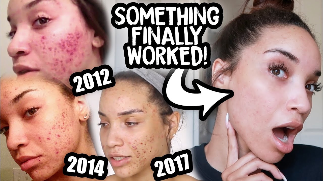 CLEAR SKIN AFTER 10 YEARS OF ACNE | My Accutane Experience with Before ...