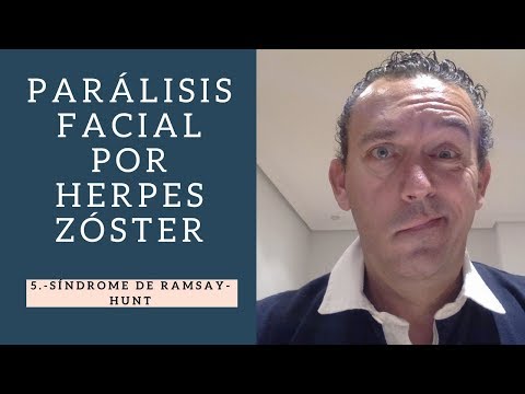 PARÁLISIS FACIAL: Síndrome de Ramsay-Hunt