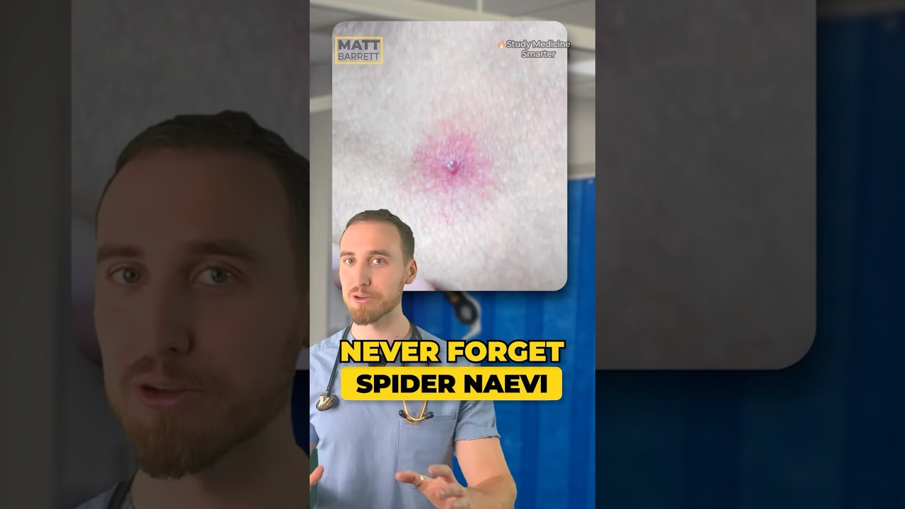Spider naevi - everything you need to know