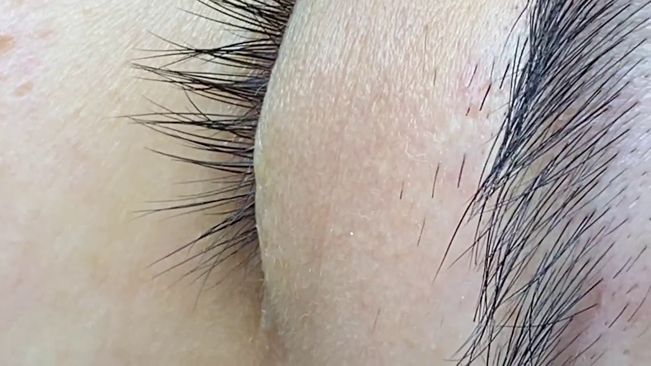 Extractions And Acne - ThuyTruong#77
