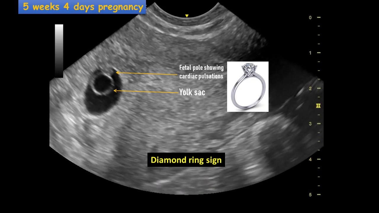 Obstetric Ultrasound Signs - YouTube