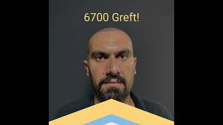 Vedat Kılıç 6700 Greft 1. Yıl Sonuç