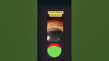 4 Types of Primary Corneal Ectasia You MUST Know 👁️🔥 #ophthalmology