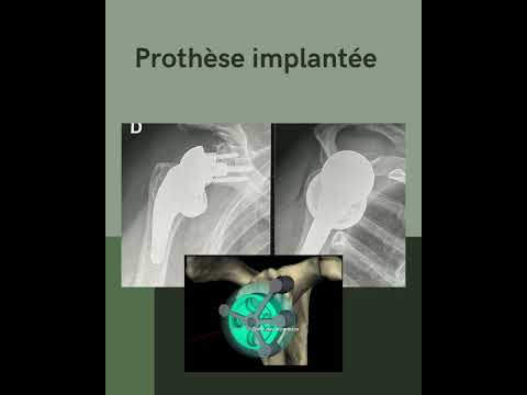 Prothèses d'épaule et planification 3D avec guide d'implantation sur mesure