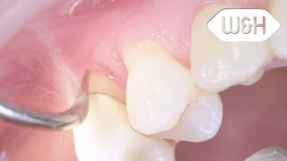 Proxeo Air Scaler and periodontology tips 1AP, 2API (English)