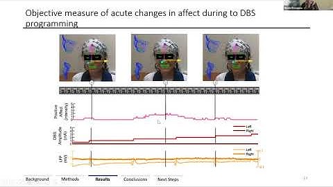 Obsessive Compulsive Disorder (OCD) and deep brain stimulation