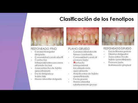 Cirugía Preprotésica Parte I UCV  Facultad de Odontología, Cátedra de Periodoncia,  Periodoncia II