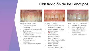 Cirugía Preprotésica Parte I UCV  Facultad de Odontología, Cátedra de Periodoncia,  Periodoncia II