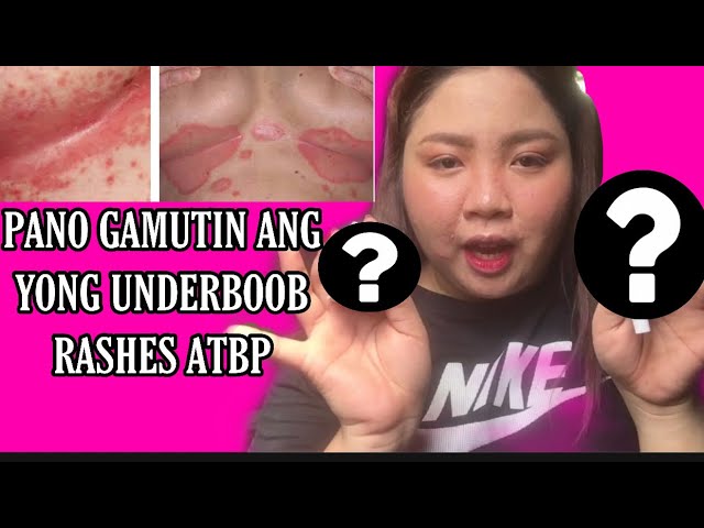 PANO GAMUTIN ANG UNDERBOOB RASHES, How to treat underboob rashes