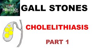 CHOLELITHIASIS/ GALL STONES-Part 1: Epidemiology, Types, Risk factors.