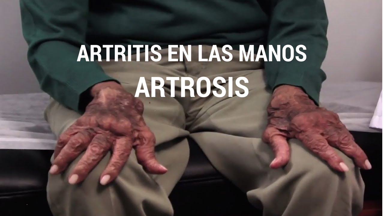 caso clinico de artritis reumatoide en ancianos