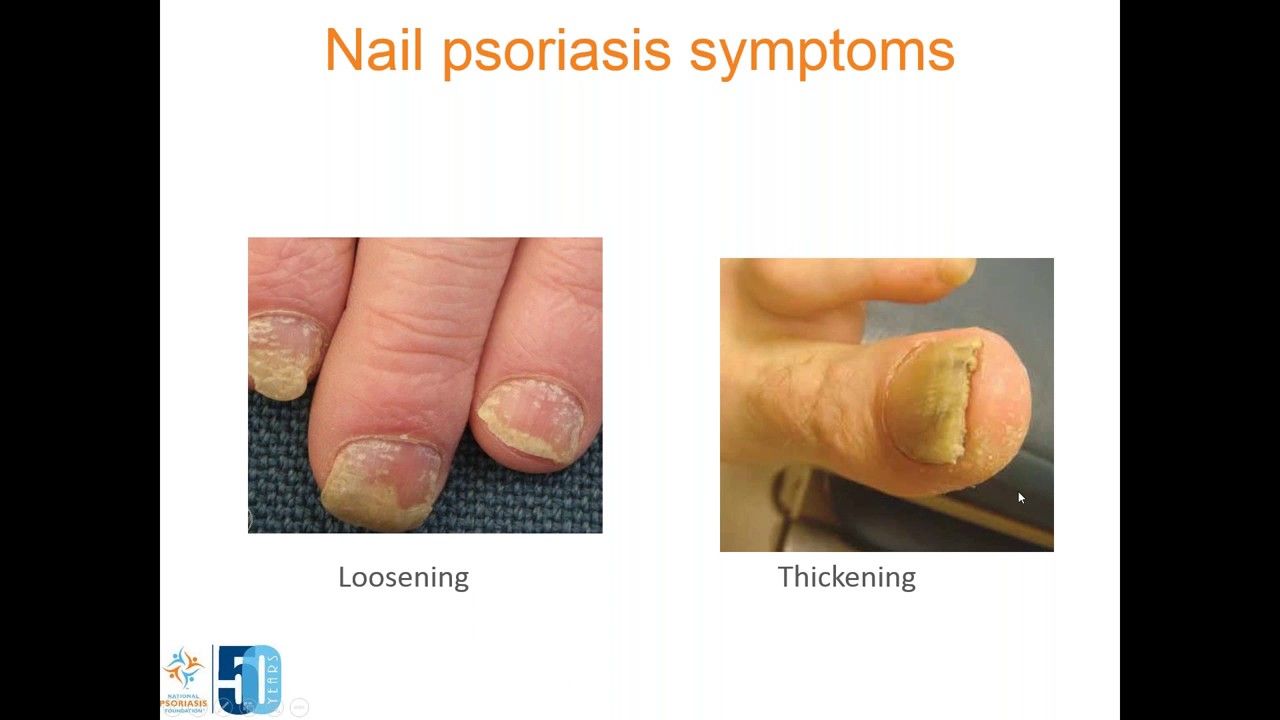 Psoriasis and the Feet: Part 1, Trimming Psoriatic Nails - YouTube