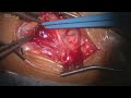 CAROTID ENDARTERECTOMY PART 1