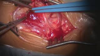 CAROTID ENDARTERECTOMY PART 1