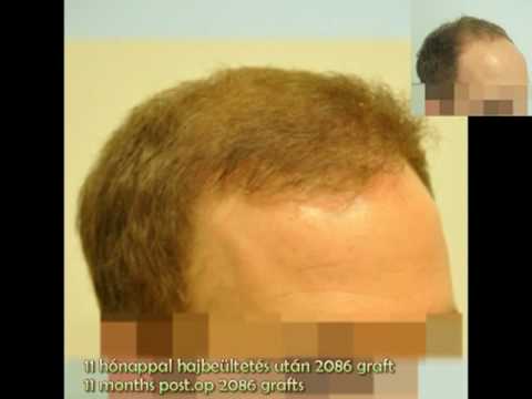 Hajbeltets hajtltets 2086 graft Sikos dr. Hair Tra...