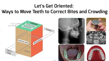Ways to Move Teeth and Correct Crowding: IPR, SD, Expansion, Proclination, Extraction