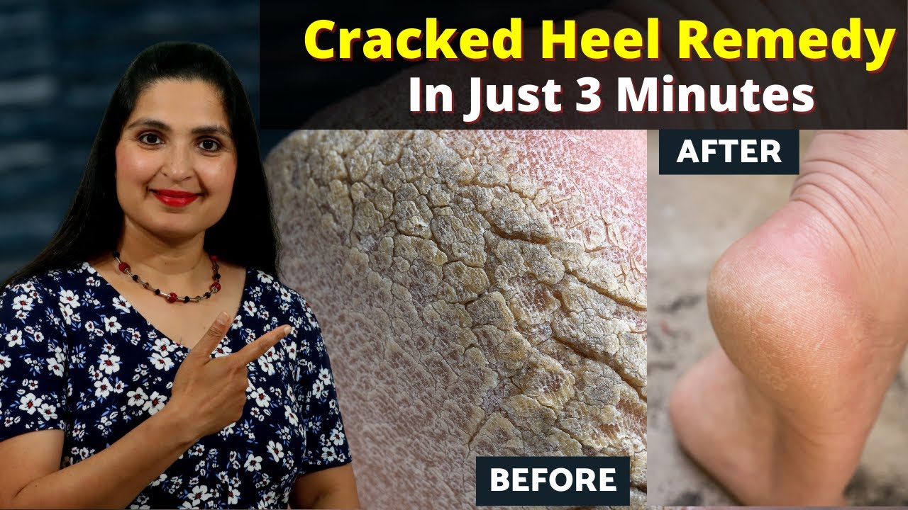 How To Make Aloe Vera DIY Cream To Treat Cracked Heels - News18