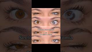 Types Of Heterochromia Eyes You May Have