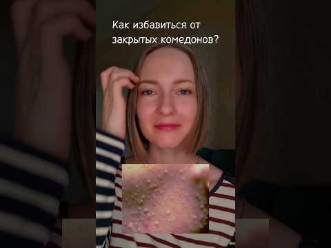Комедоны перестанут вас