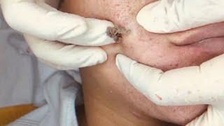 Pimple Popping 2020 Video Super Acne Shoots Out Blackheads Removal Acne Removalacne Treatment
