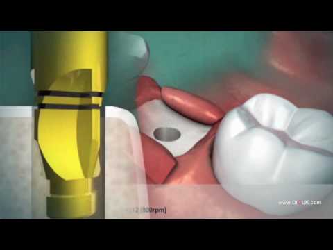 DIO Implant Surgical Protocol, Drilling Sequence dental implants