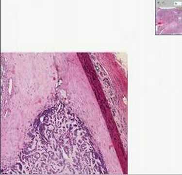 Adenoid Cystic Carcinoma Prognosis, Symptoms And Treatment