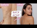 HOW TO GET RID OF BACK ACNE (bacne)