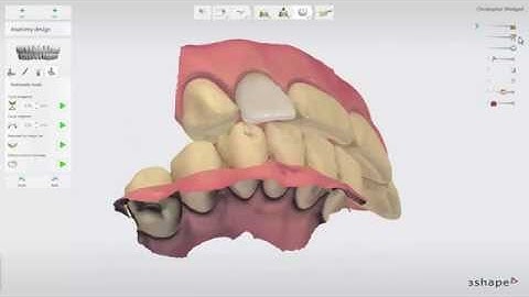 TRIOS® Practice lab  In depth veneer design