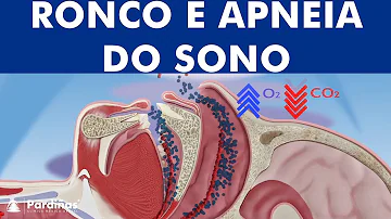 O que causa a apneia do sono?