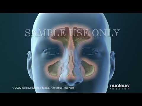 Sinusitis Surgery