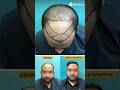 Hair Transplant Before & After | Dr.Jangid | Real Result #hairtransplant #beforeafter #result