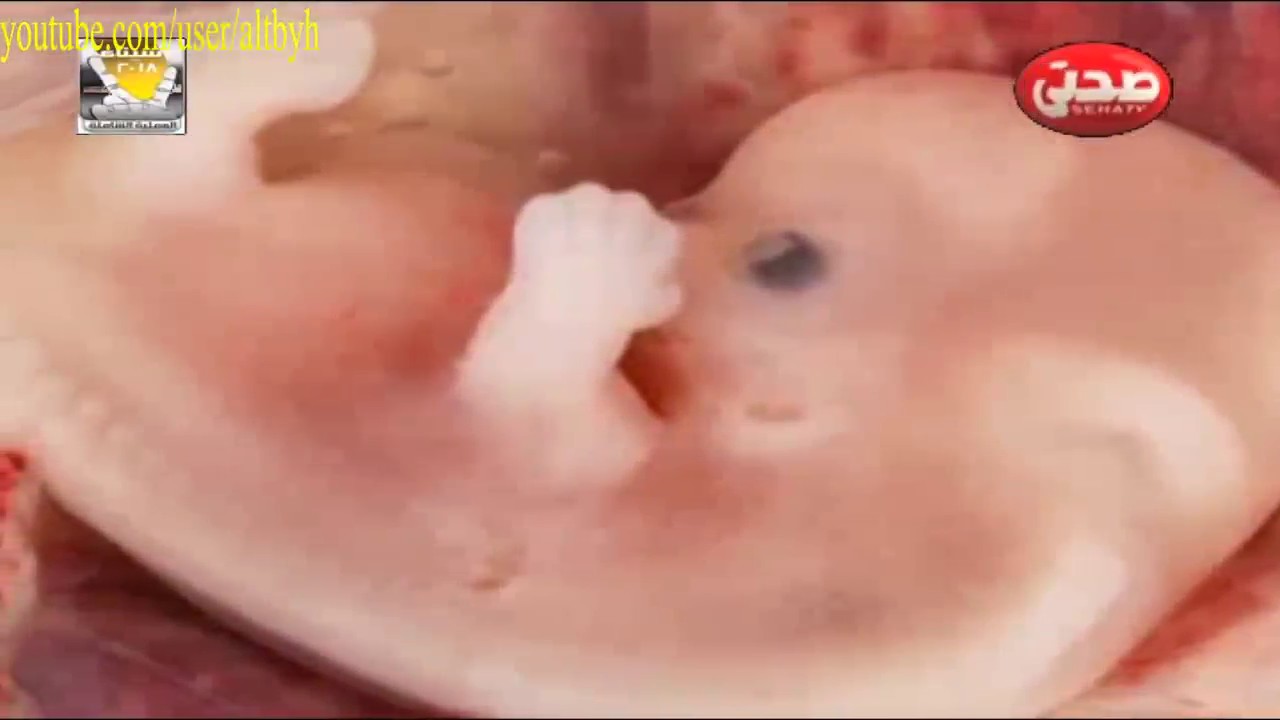 تأثير زيادة السائل الامنيوسي على الجنين