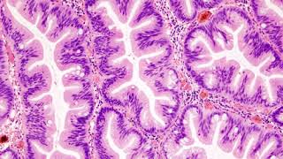 Vacuum-assisted breast biopsy | Wikipedia audio article