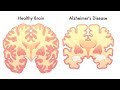 5 Habits That May Reduce Your Risk for Developing Alzheimer's