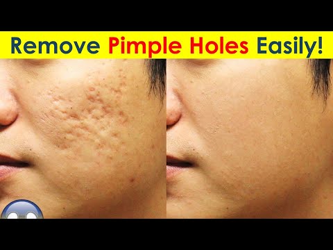  Ways to Remove Pimple Holes, Acne Scars & Pimple Marks Fast