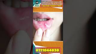 வாய் புண் ஏன் வருது  Mouth Ulcer Treatment & Home Remedy  