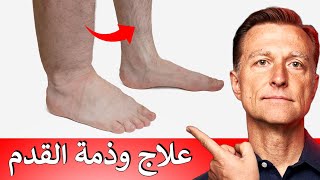 أفضل علاج طبيعي للوذمة (انتفاخ القدم)