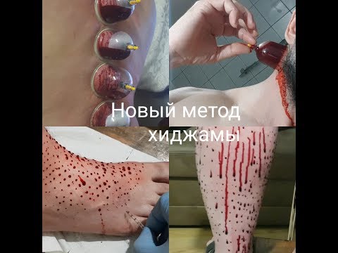 Video: Co je hijama a k čemu je