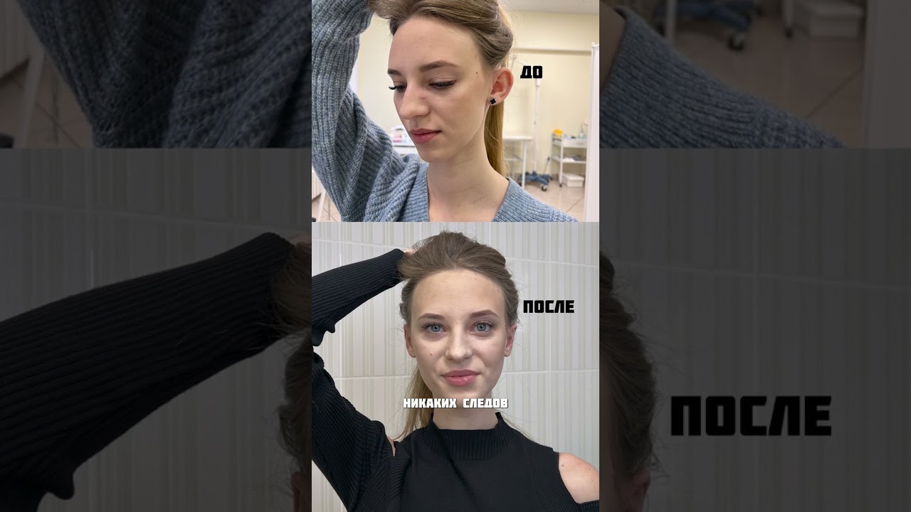 ОТОПЛАСТИКА - ЭТО ОПЕРАЦИЯ ДЛЯ    