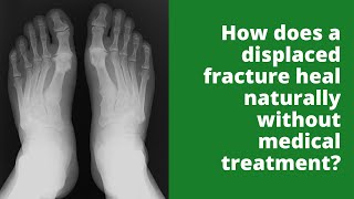 How does a displaced fracture heal naturally without medical treatment?