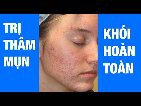 Trị sạch thâm do mụn trứng cá bằng laser cao cấp tại Phòng Khám Maia&Maia