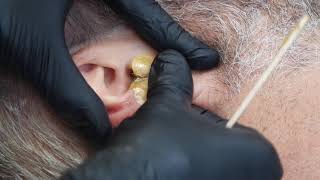Ear Wax Using Outback Organics Peelables
