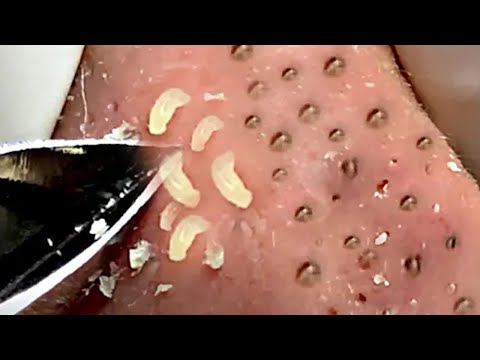 【激ゴッソリ！！】角質除去☆Blackheads⑩