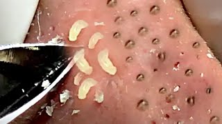 【激ゴッソリ！！】角質除去☆Blackheads⑩