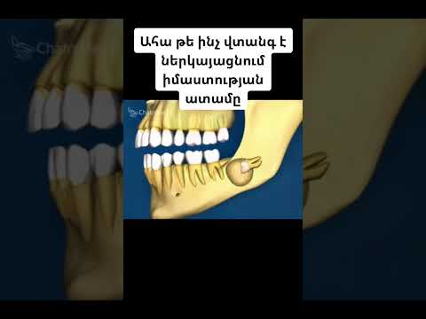 Video: Իմաստության ատամները պետք է ցավե՞ն: