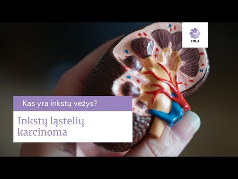 Video: 3 būdai, kaip padėti žmogui, kuriam diagnozuotas vėžys