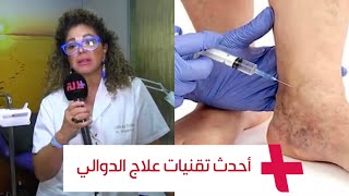 مرض الدوالي.. طبيبة تكشف أحدث تقنيات العلاج