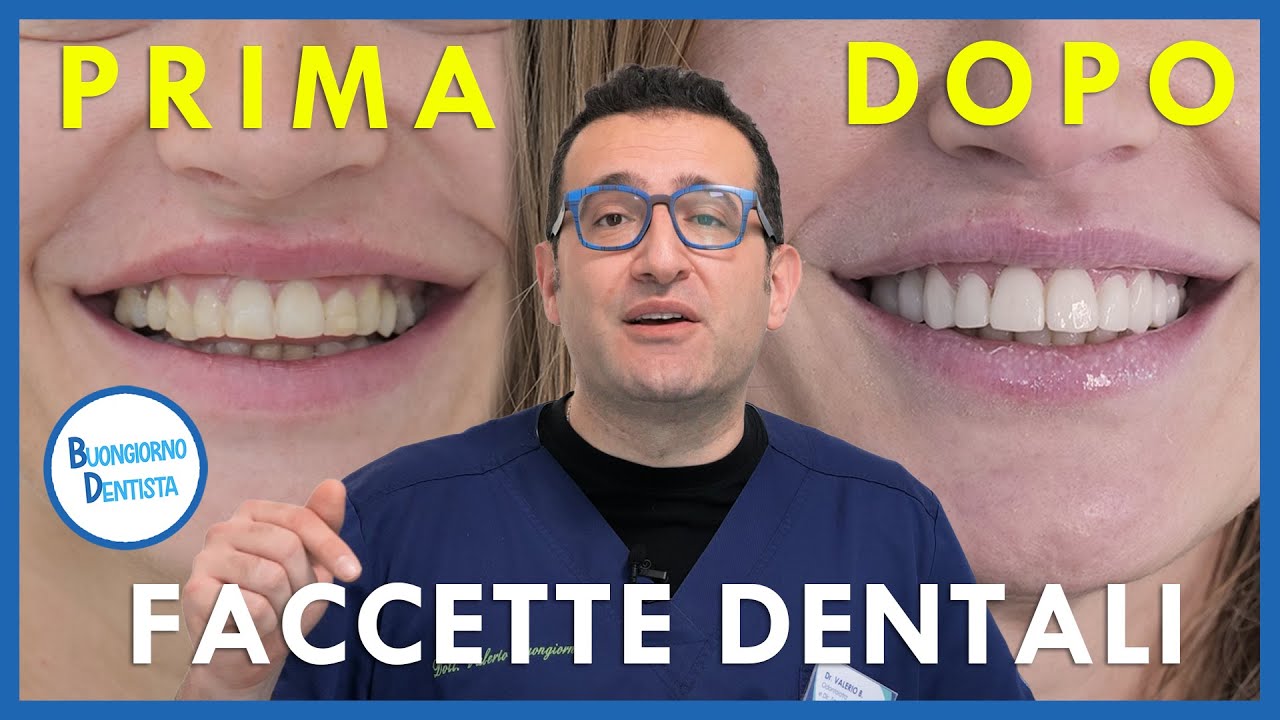 Faccette Dentali: Denti Storti o Macchiati ecco la soluzione. Il Caso Prima Dopo