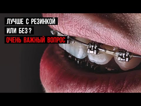 Какие брекеты лучше❓Лигатурная или безлигатурная брекет-система.